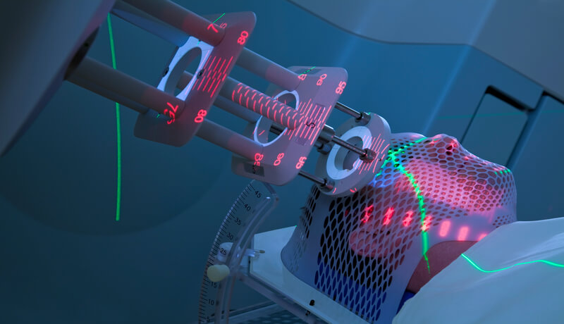 Homed-Radiation Therapy Neurological Damage