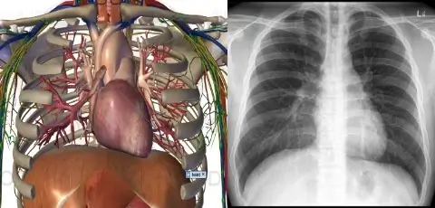 Chest x ray compared with artificial model