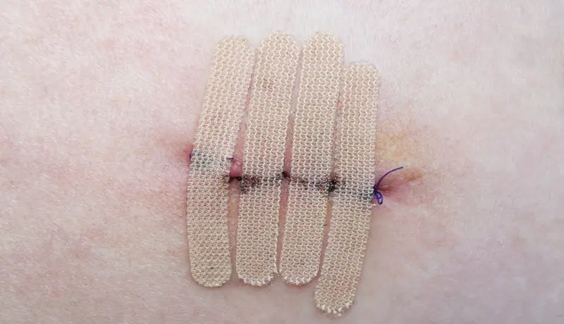 Close-up of a surgical wound closed with sutures and adhesive strips for secure healing.