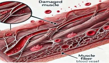 Homed-Rhabdomyolysis