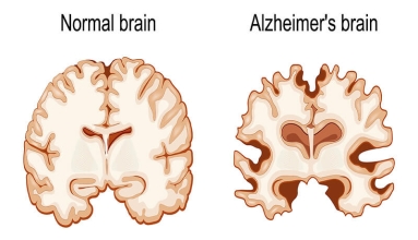 Homed-Alzheimer's-Related Changes in the Brain