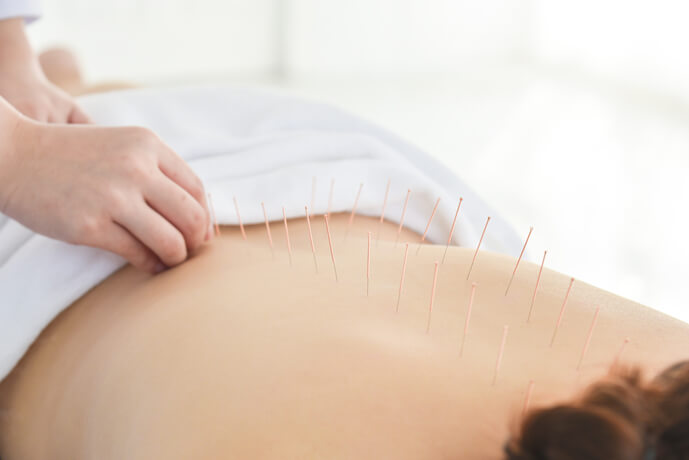 Homed-Acupuncture Therapy