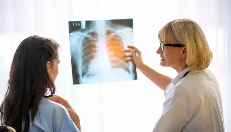 Γιατρός που εξηγεί ακτινογραφία θώρακα σε ασθενή, δείχνοντας σημεία πιθανής πνευμονίας στους πνεύμονες.v