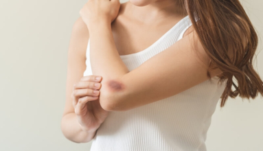 Homed-Bruising Bleeding Disorders