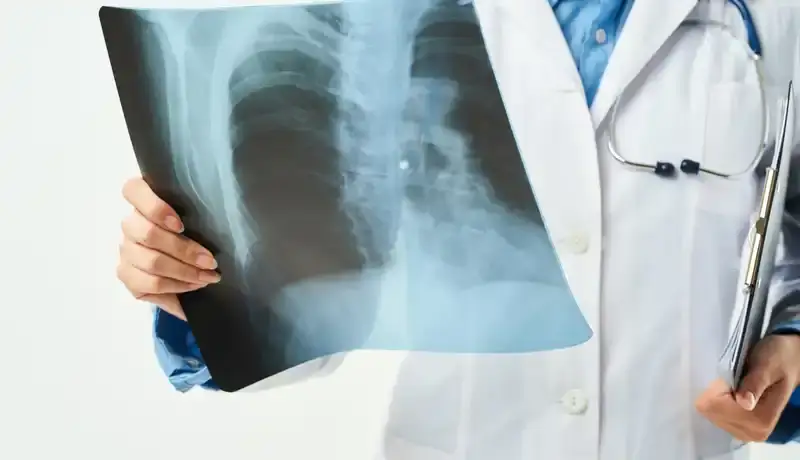 Γιατρός εξετάζει ακτινογραφία θώρακα για πιθανά κατάγματα στις πλευρές και προβλήματα πνευμόνων.