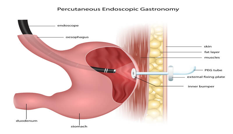 Homed-Γαστροστομία