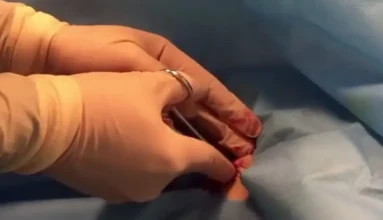 insertion of Bulaw catheter