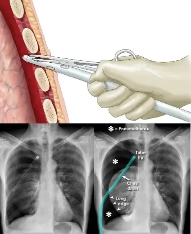 insertion of chest drainage tube in comparison to x rays