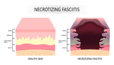 Homed-Necrotizing Skin Infection Treatment