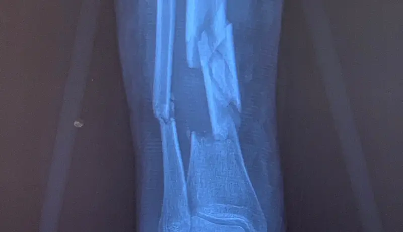 Homed-Pilon Fracture