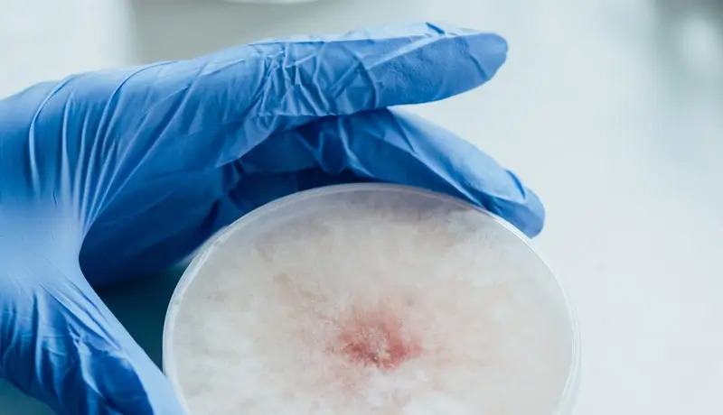  A gloved hand holding a petri dish with bacterial culture, representing laboratory analysis related to post-streptococcal glomerulonephritis (PSGN).