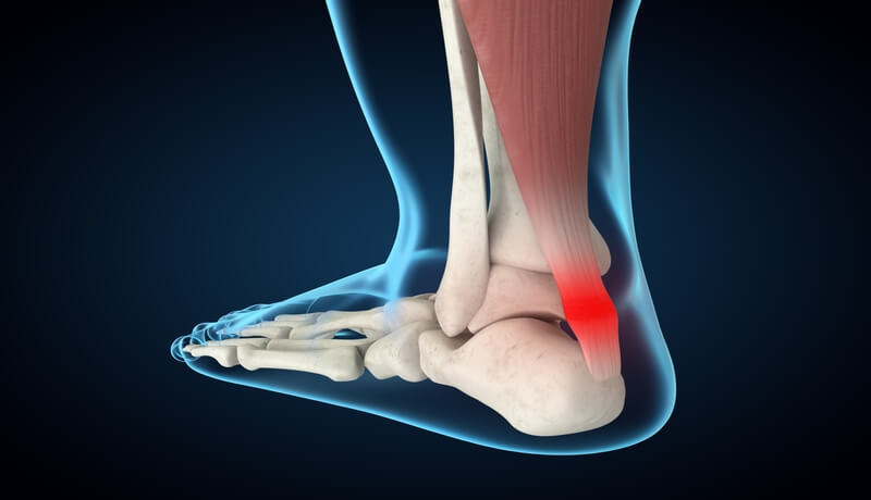 Homed-Achilles Tendinitis : Causes and Treatmeant